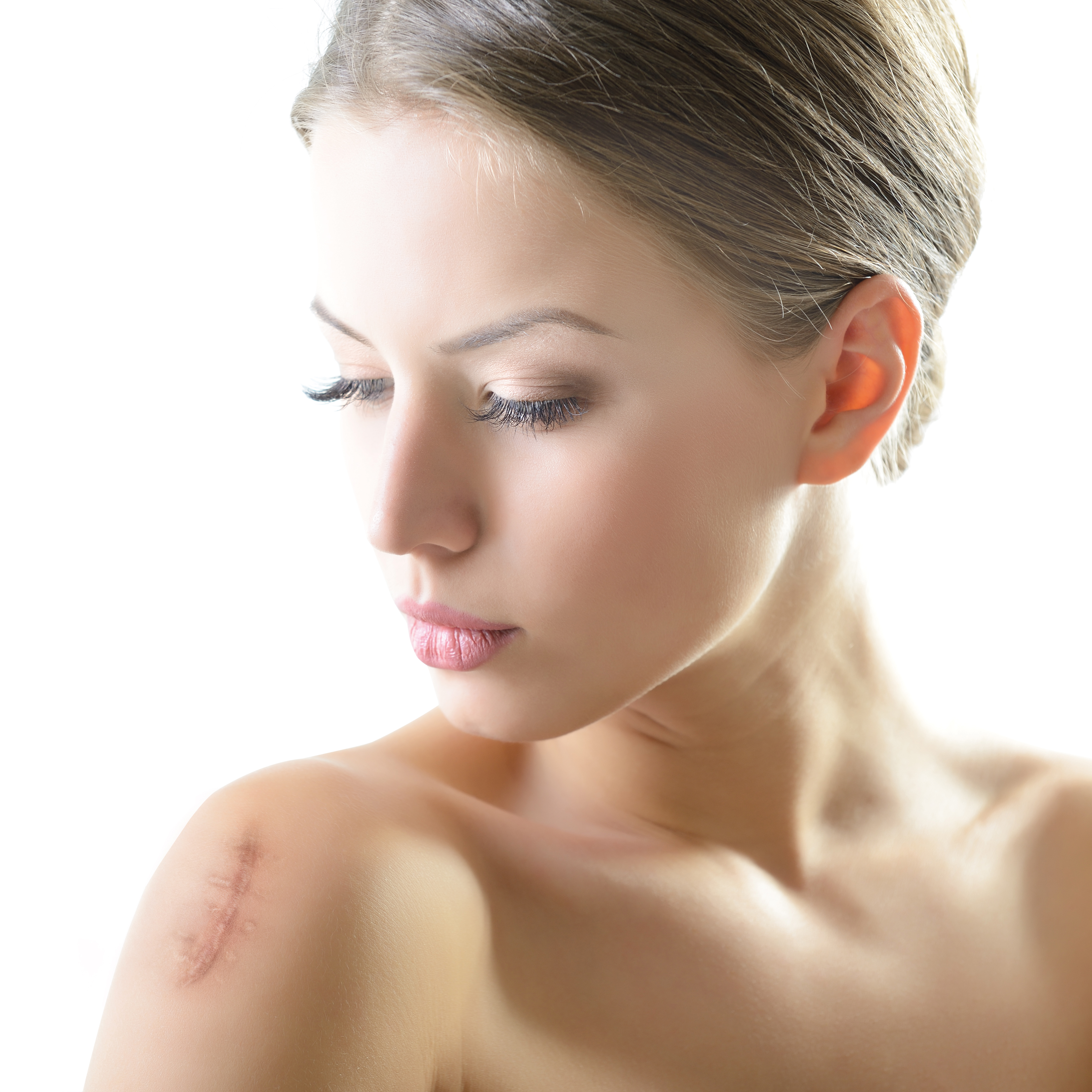 Can you remove or treat a keloid scar?