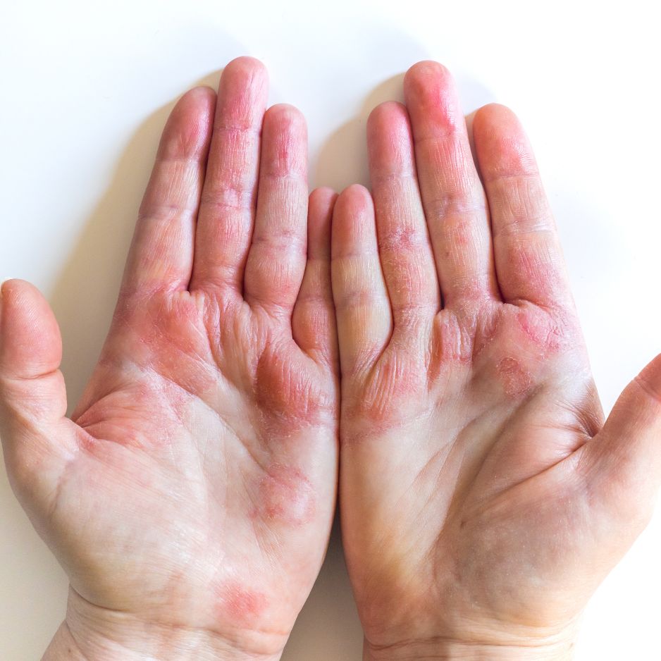 Eczema Relief: 5 Simple Tips for Soothing Hand Eczema