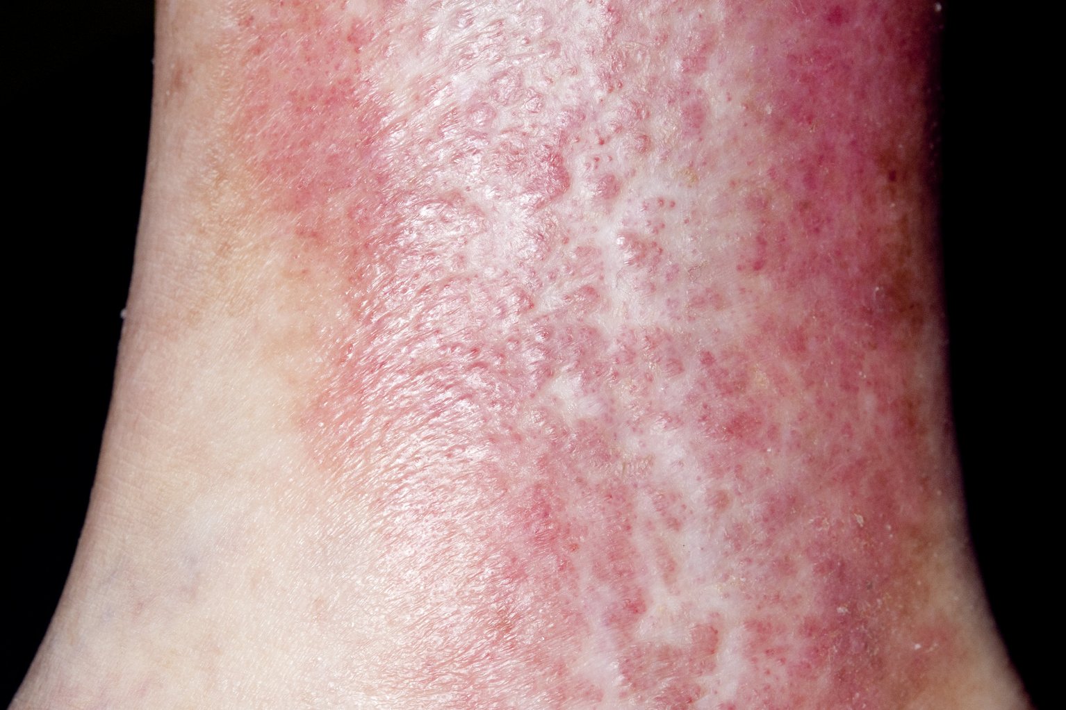Beyond Comfort: DermaSilk's Impact on Varicose Veins and Gravitational Eczema Management